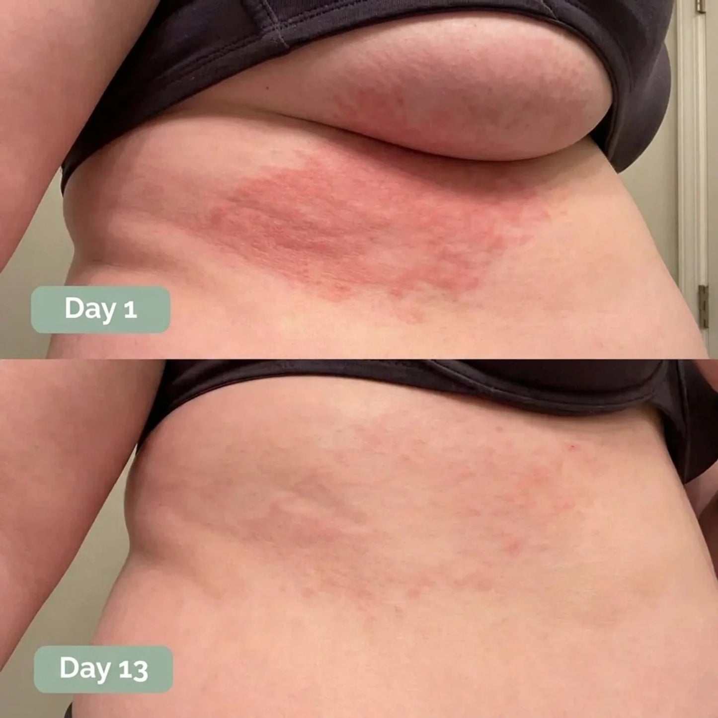 CalmFold™ SkinFold AntiFungal Soap